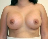 Breast Augmentation Case 29 - after