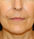 Lip Lift 201 - before