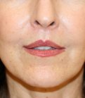 Lip Lift 201 - after