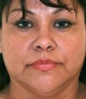 Rhinoplasty Case 2 - before
