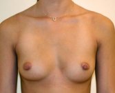 Breast Augmentation Case 30 - before