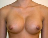 Breast Augmentation Case 30 - after