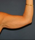 Arm Reduction 201 - before