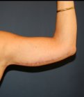 Arm Reduction 201 - after