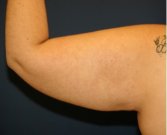 Arm Reduction 202 - before