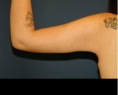 Arm Reduction 202 - after