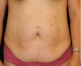 Tummy Tuck 205 - before