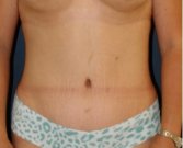 Tummy Tuck 205 - after