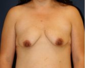 Breast Augmentation-Lift 51 - before