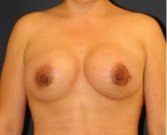 Breast Augmentation-Lift 51 - after
