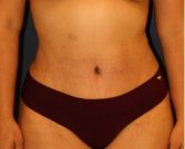 Tummy Tuck 206 - after