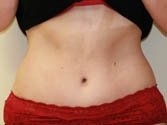 Tummy Tuck Case 3 - after