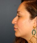 Rhinoplasty 200 - before