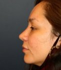 Rhinoplasty 200 - after