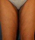 Thigh Lift 200 - before