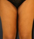 Thigh Lift 200 - after