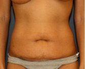 Tummy Tuck 207 - before