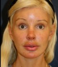 Browlift Foreheadplasty 100 - after