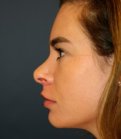 Revision Rhinoplasty 201 - before