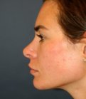 Revision Rhinoplasty 201 - after