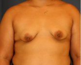 Breast Augmentation Lift 53 - before