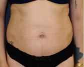 Tummy Tuck 208 - before