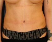 Tummy Tuck 208 - after