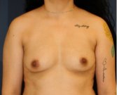 Breast Augmentation 132 - before