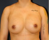 Breast Augmentation 132 - after