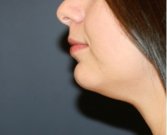 Neck Liposuction 202 - before