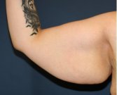 Arm Reduction 203 - before