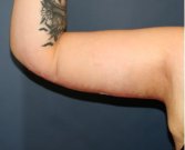 Arm Reduction 203 - after