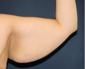 Arm Reduction 204 - before