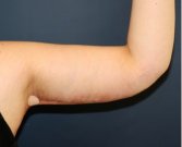 Arm Reduction 204 - after