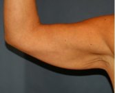 Arm Reduction 205 - before