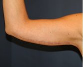 Arm Reduction 205 - after