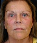 Laser Facial Skin Treatment 201 - before