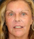 Laser Facial Skin Treatment 201 - after