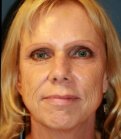 Laser Facial Skin Rejuvenation - before