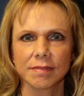 Laser Facial Skin Rejuvenation - after