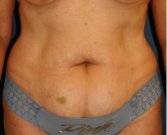 Tummy Tuck 209 - before