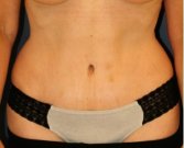 Tummy Tuck 209 - after