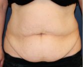 Tummy Tuck 210 - before