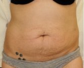 Tummy Tuck 211 - before