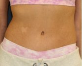 Tummy Tuck 211 - after