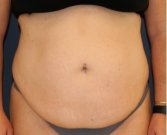 Tummy Tuck 212 - before