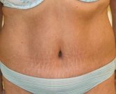 Tummy Tuck Case 6 - after