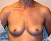 Breast Augmentation Case 33 - before