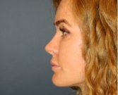 Revision Rhinoplasty 202 - before