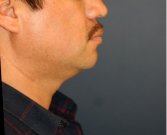 Neck Liposuction and Chin Implant 202 - before